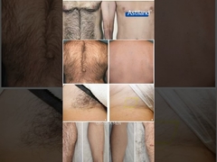 การกําจัดผมด้วยเลเซอร์ ก่อนและหลัง