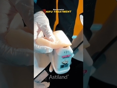 ส่องความสามารถในการยกของ HIFU ที่ไม่บุกรุก