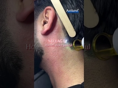 เลเซอร์ไดโอเดส VS เลเซอร์ ND YAG คุณชอบไหนดี?