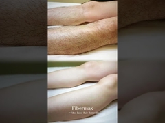 นําเสนอเครื่องกําจัดผมเลเซอร์ไฟเบอร์ล่าสุด แอสติแลนด์ ไฟเบอร์แม็กซ์