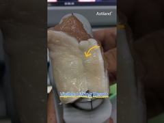 มาตรวจสอบผลลัพธ์การยกกระชับผิวแบบทันทีทันใดของ HIFU กัน