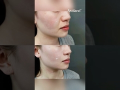 คุณเคยลอง RF+ HIFU เพื่อกระชับผิวไหม? #AntiAging #SkinLift #beautyclinic #facialtreatment